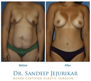 Before and after images of Dr. Jejurikar's mommy makeover patient.